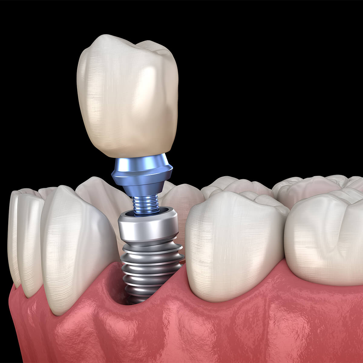 Biocompatible Dental Implants in San Diego CA Area